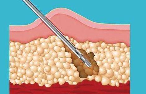 吸脂瘦臀的手術(shù)方式有哪些？這些技術(shù)須知！