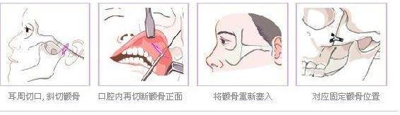 怎么磨顴骨？原來手術(shù)的過程是這樣的！