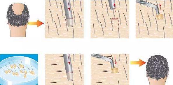 頭發(fā)種植術(shù)多少錢?怎么收費(fèi)?