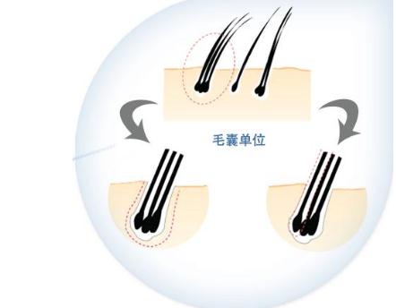 頭發(fā)種植要多久才能恢復(fù)？