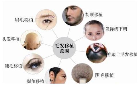 頭發(fā)種植多少錢？一個(gè)單位多少錢？