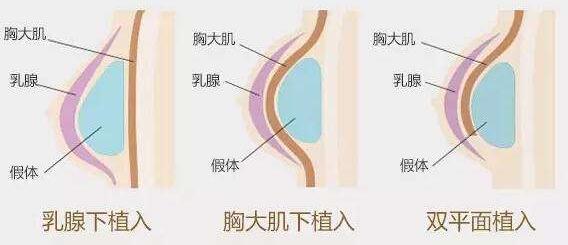 假體隆胸取出之后要放置新的假體嗎？