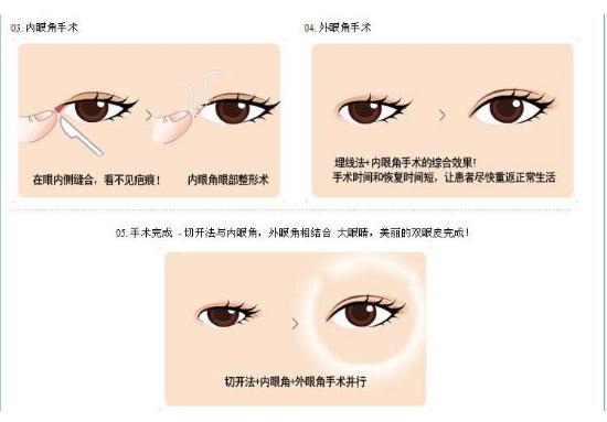 北京眼部手術(shù)比較好的醫(yī)生有哪些？?jī)?yōu)質(zhì)醫(yī)生名單