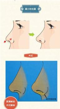 硅膠隆鼻能******嗎？可以保持一輩子嗎？