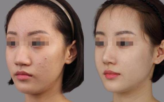 聽(tīng)說(shuō)*********脂肪隆鼻成活率很高，忍不住去體驗(yàn)了一下……