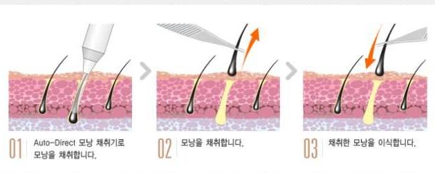 天津植發(fā)哪里好？費(fèi)用大概多少？