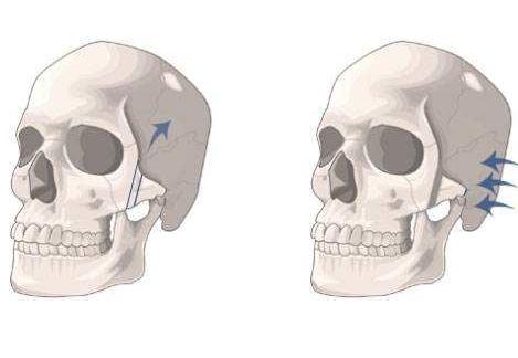 顴骨整形手術(shù)只有這些醫(yī)院能做！你知道嗎？