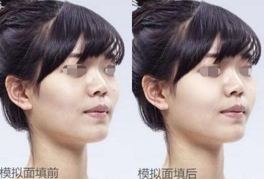 面部脂肪填充十年后是什么樣子？臉會(huì)塌陷嗎？