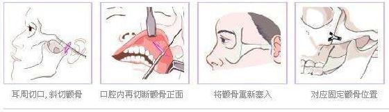 上海顴骨整形哪家醫(yī)院好？看看有心儀的沒~