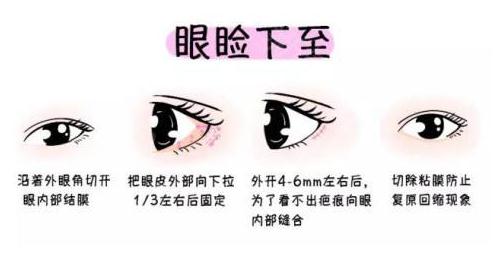 下眼瞼下至術(shù)