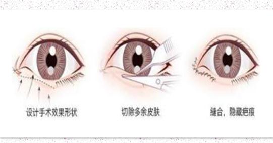 眼瞼下至多久恢復(fù)自然?