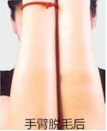 冰點(diǎn)脫毛的副作用