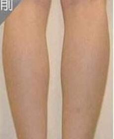 瘦腿吸脂的果好嗎？