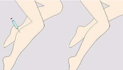 注射瘦腿的果好嗎？