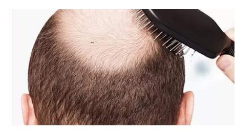 植發(fā)有后遺癥嗎？術(shù)前必看篇~