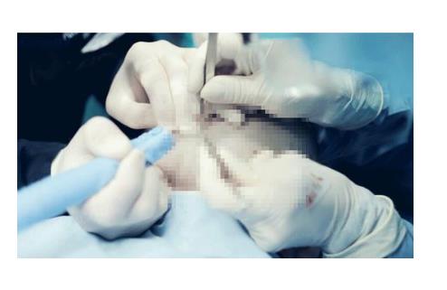 植發(fā)有后遺癥嗎?