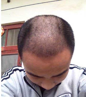 植發(fā)后的注意事項