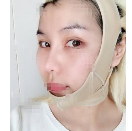 顴骨顴弓整形的方法