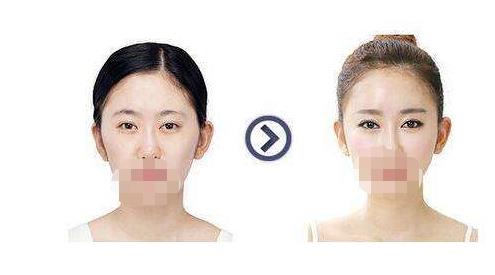 高顴骨整形手術果