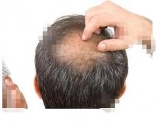 禿頂能植發(fā)嗎？拯救你的“地中?！?！