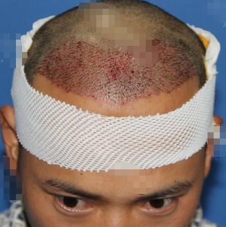 植發(fā)后的注意事項