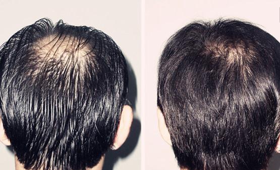 植發(fā)補(bǔ)發(fā)的過(guò)程