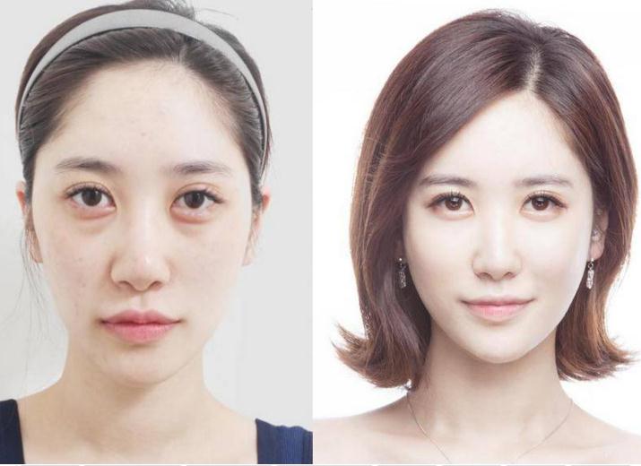 面部脂肪填充后遺癥是什么？怎樣避免后遺癥？