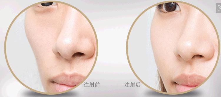 面部脂肪填充后遺癥是什么?