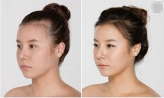 補(bǔ)發(fā)植發(fā)是真的有嗎？受大眾歡迎是有原因的