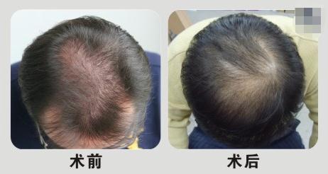 杭州植發(fā)醫(yī)院哪家好？如何挑選正規(guī)的醫(yī)院？