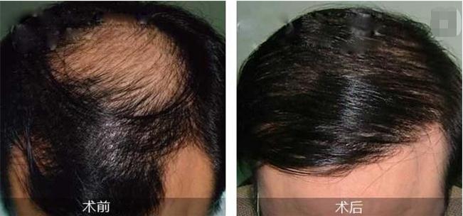 杭州毛發(fā)移植醫(yī)院哪家好，如何選擇？