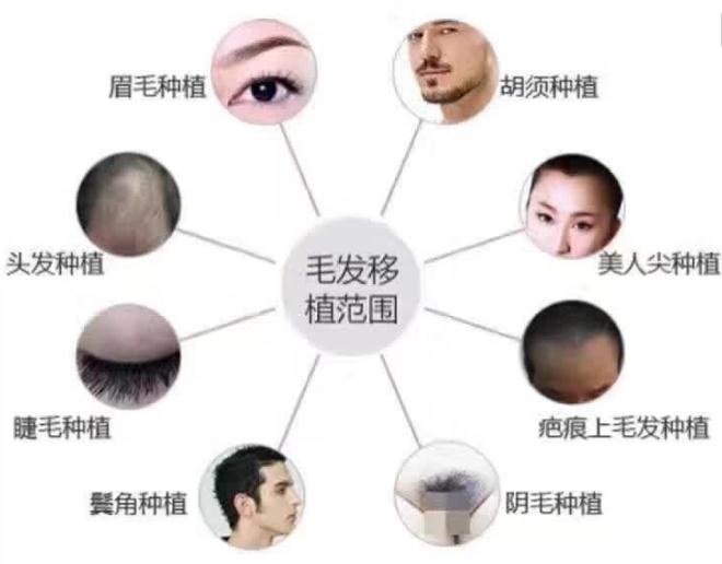 植發(fā)后的注意事項