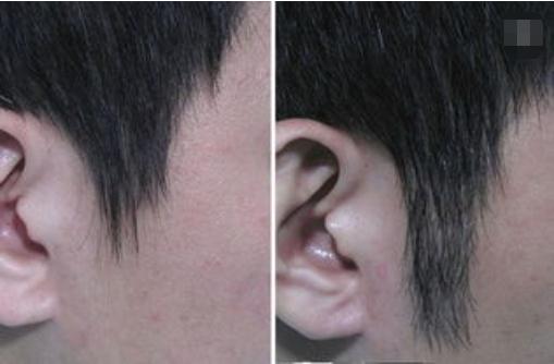 鬢角種植手術(shù)前注意