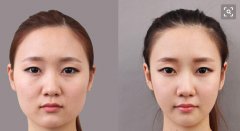 都說顴骨整形術(shù)很危險(xiǎn)，它的危險(xiǎn)性真的很高嗎？