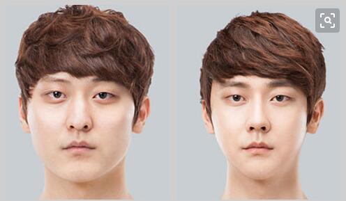 整形顴骨維持多久？