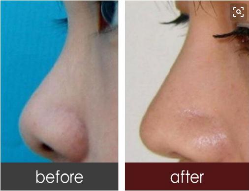 硅膠隆鼻能放一輩子嗎？硅膠的使用期限是多久？