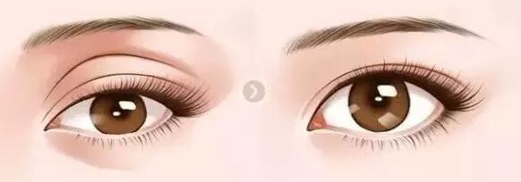 上海華美葉麗萍做雙眼皮怎么樣 簡介