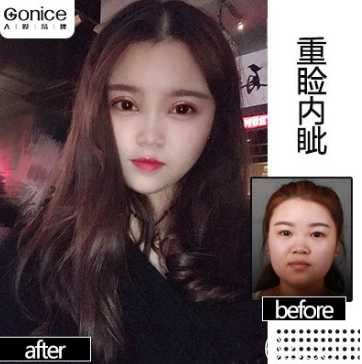 西安高一生雙眼皮案例