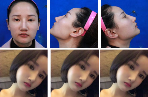 上海華美下頜角整形案例對(duì)比