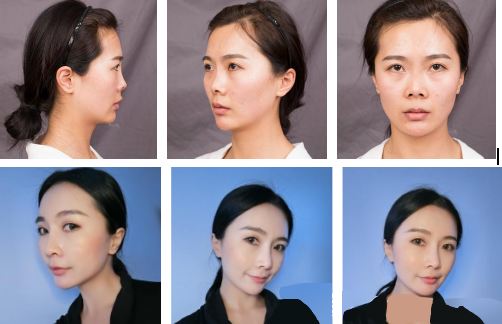 上海華美鼻部手術(shù)怎么樣？