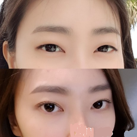 韓國的純真整形手術(shù)對整形手術(shù)有好處嗎？