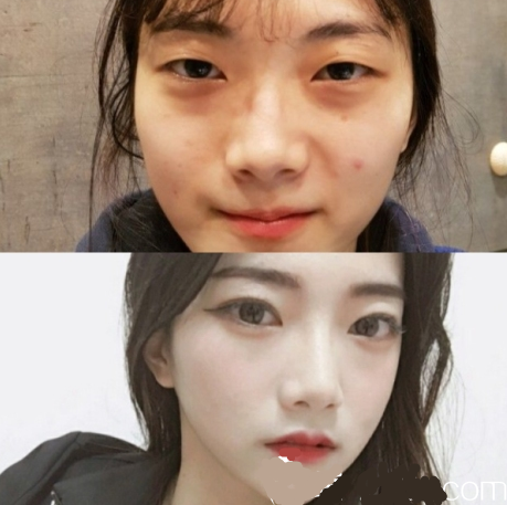 韓國的純真整形手術(shù)對整形手術(shù)有好處嗎