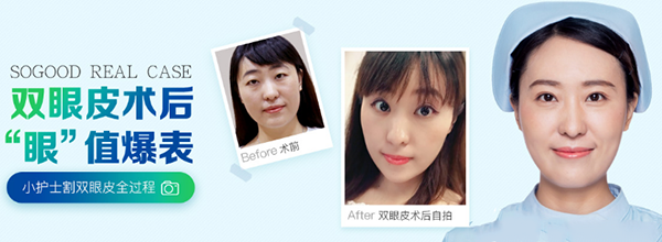 王娟切開雙眼皮案例果圖：廣州曙光王娟雙眼皮案例