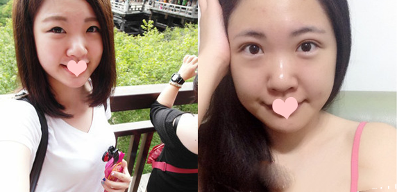 王娟醫(yī)生做的切開雙眼皮案例