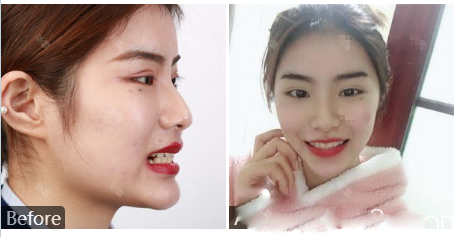 劉杰偉260cc曼托假體隆胸隆胸案例