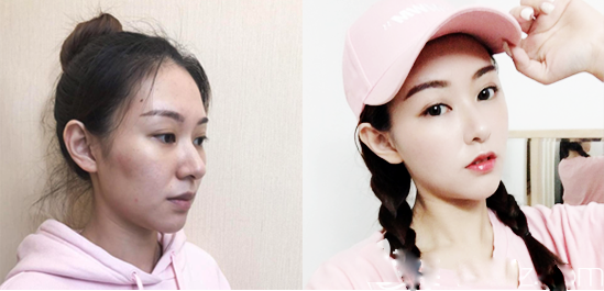 廣州曙光程鵬做的隆鼻和自體脂肪面部填充案例