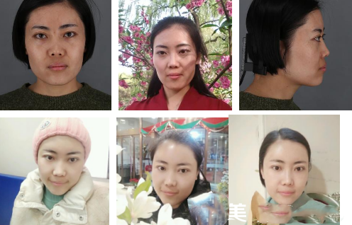 自體脂肪填充全臉