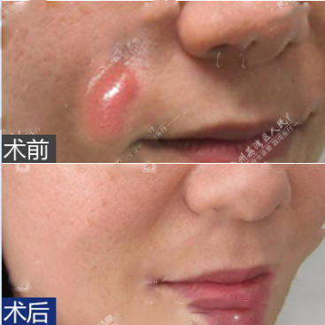 廣州荔灣區(qū)人民醫(yī)院取出面部omedine病例比較