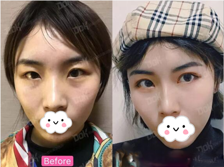 成都銅雀臺(tái)雙眼皮術(shù)前術(shù)后對(duì)比照