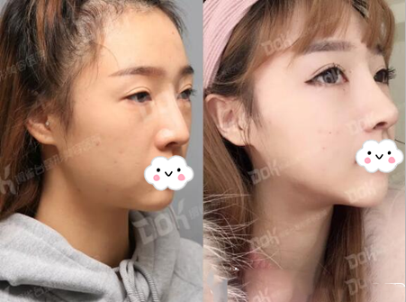 成都銅雀臺(tái)鼻部手術(shù)術(shù)后果圖